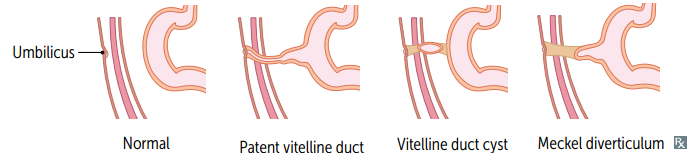 Meconium discharge from the umbilicus