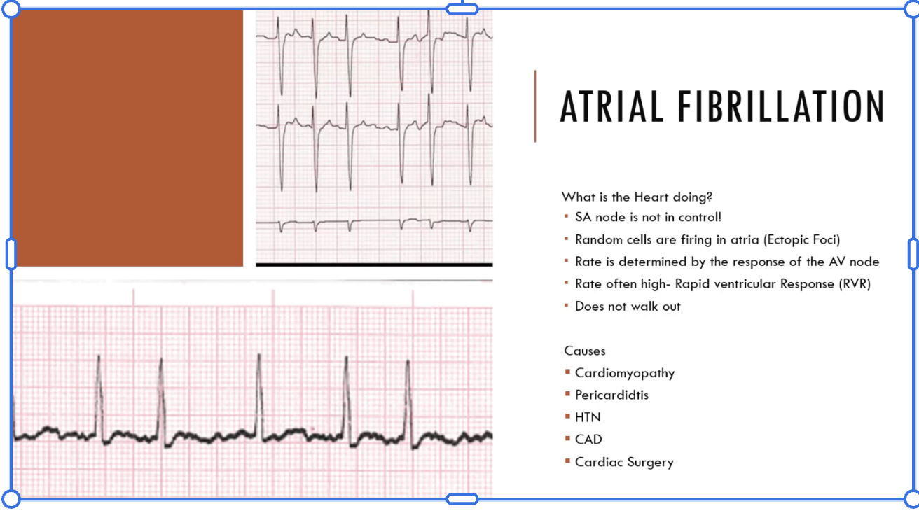 <p>(PT2) atrial fibrillation</p>