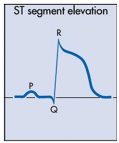 <p>ST elevation</p>