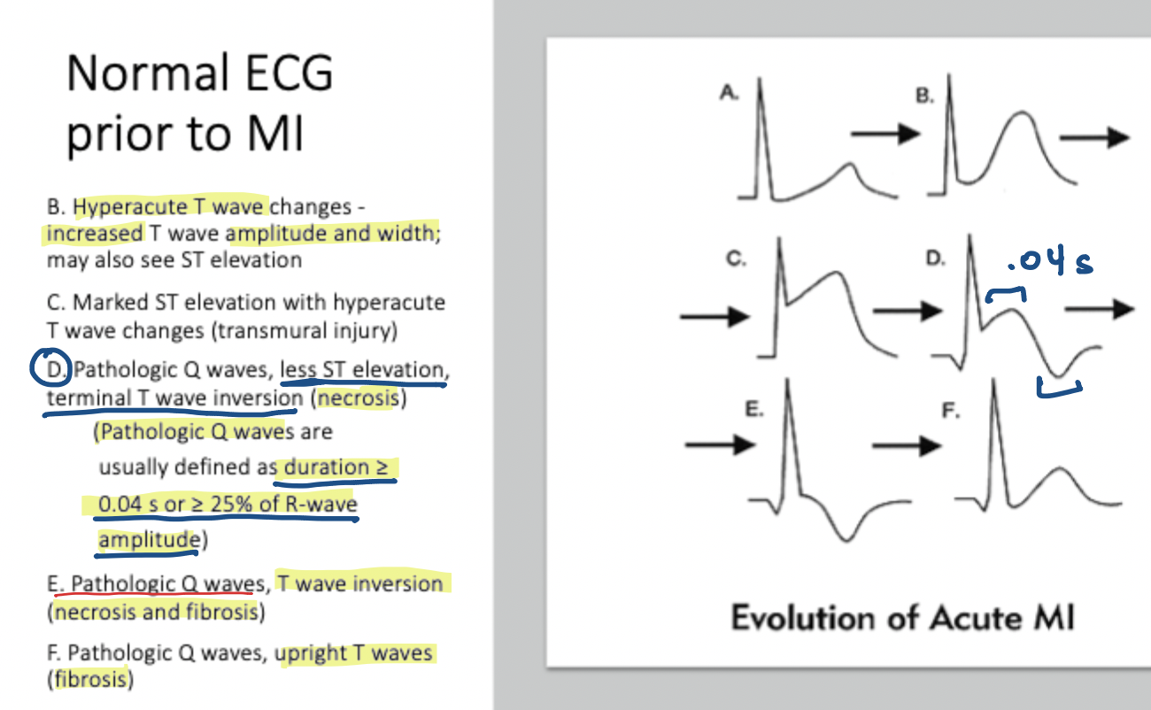 <p>$$\ge 25\%\text{ of R-wave amplitude}$$ </p>