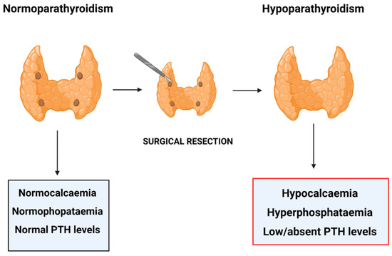 <p>Transient hypoparathyroidism</p>
