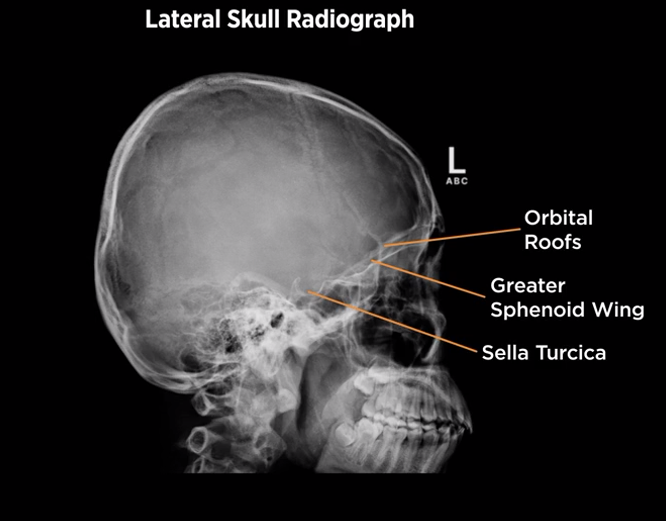 <p>Lateral Skull X-ray</p>