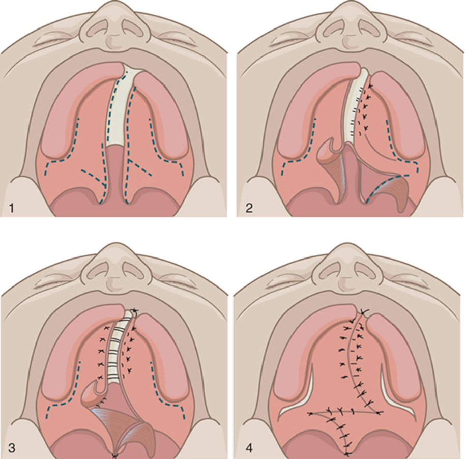 <p>What VPI surgery is this? </p>