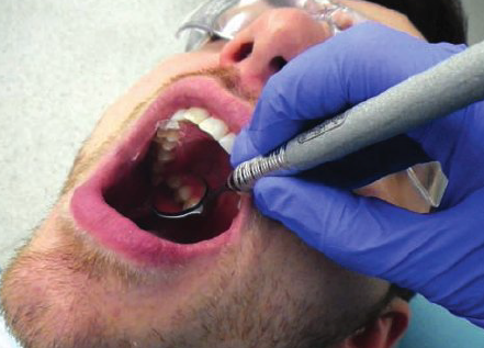 <ul><li><p>3 o’ clock position</p></li><li><p>Rest ring and pinkie on left sid eof patient’s mouth, near corner </p></li><li><p>Position mirror head away from teeth, closer to tongue</p></li><li><p>Use mirror for indirect vision, to view distal surfaces. Swivel mirror head until you can easily view the distal surfaces in reflection.</p></li></ul><p></p>