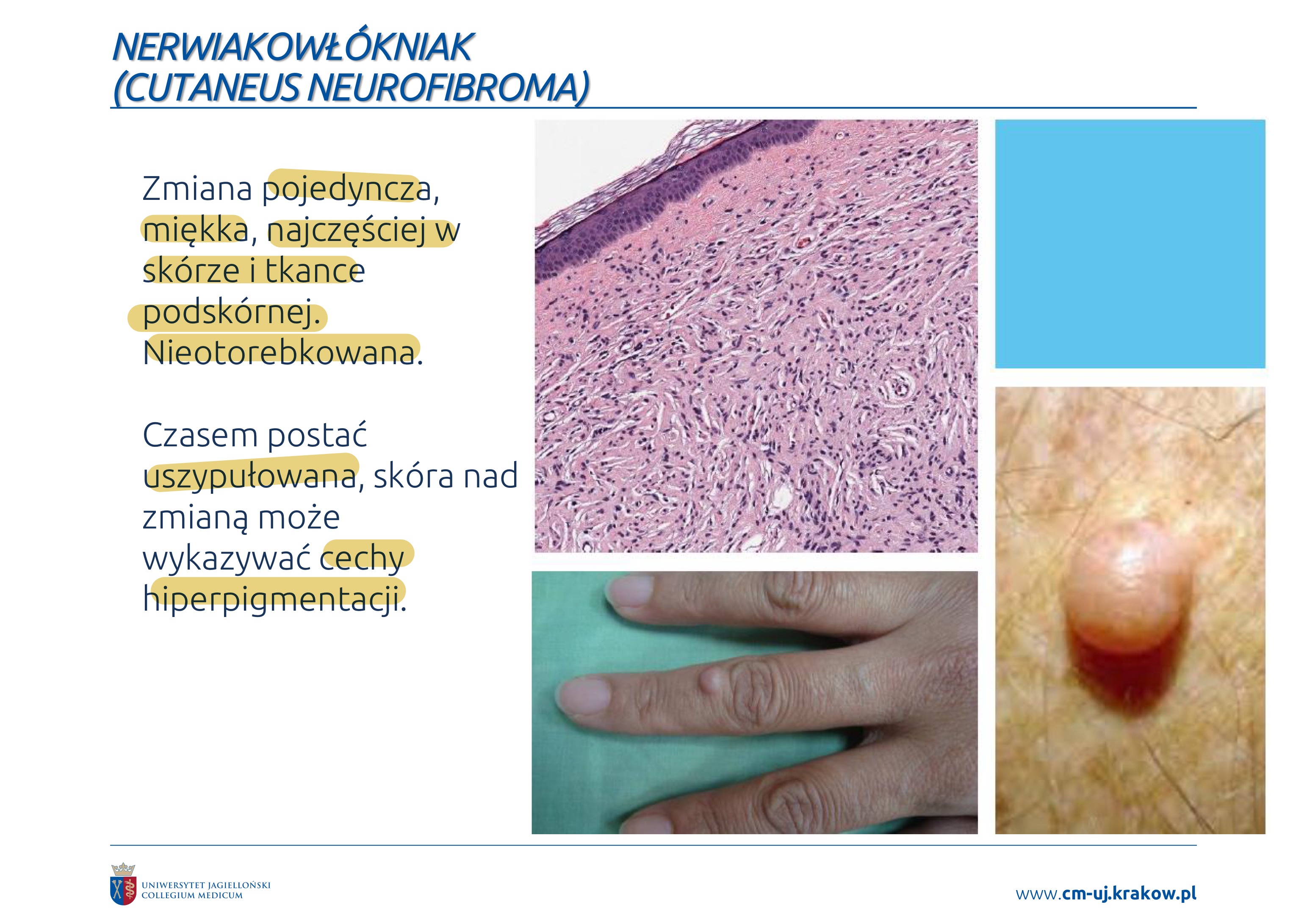 <p>❖ Delecja genu NF1 lub utrata funkcji jego produktu białkowego</p><p>(neurofibromina) (inhibitor onkoproteiny Ras)</p><p>❖ Spontaniczny lub składowa nerwiakowłókniakowatości typu 1</p><p>(choroba von Recklinghausena)</p>