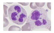 <p>- Neutrophil count <1.5 x 10^9/L</p><p>.</p><p>Causes:</p><p>- Congenital (rare); Benign ethnic neutropenia</p><p>- Drug-induced: Antibiotics; cytotoxics</p><p>- Infections: Viral or bacterial</p><p>- Bone marrow failure (pancytopenia)</p><p>.</p><p>- Risk of severe &amp; recurrent bacterial infection</p><p>- Assoc. with infections of mouth and throat</p><p>.</p><p>Therapy:</p><p>- Treat underlying cause</p><p>- Antibiotics: prophylactic for procedures</p>