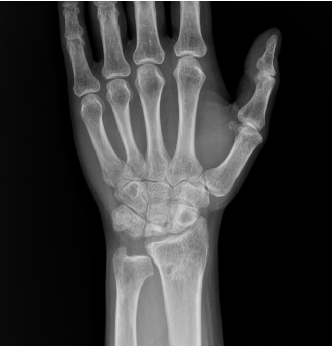 <p>Ulna is unusually shorter than the radius, seen with scapho-lunate dislocation </p>