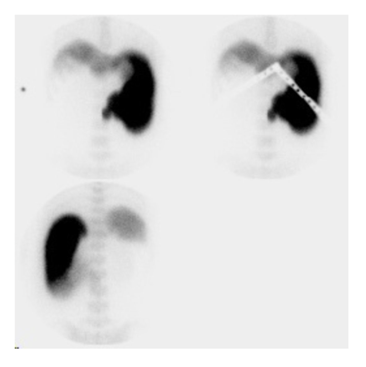 <p>What best describes the liver/spleen images below?</p><p>Top 2 images are from the anterior and the bottom image is from the posterior</p><p>This study shows colloidal shift with decreased liver function</p><p>The patient has abnormal stomach uptake</p><p>This is a normal appearing study</p><p>This study shows an infarcted spleen</p>