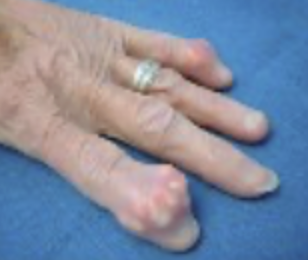 <ul><li><p>buildup of urate crystals in joint spaces</p></li><li><p>PAINFUL!</p></li><li><p>swelling, redness, warmth </p></li><li><p>once you have what is in the photo → it will not go away</p></li></ul><p></p><p>Colchicine (acute), Alloprinol (chronic), Low-purine diet (no meats, selfish, alcohol)</p><p></p>