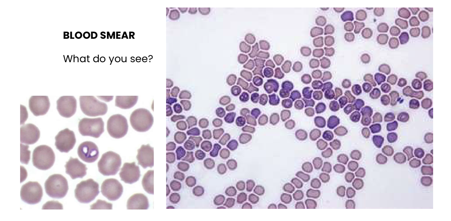 <p>Q1. What do you see?</p><p>Q2. <span>Which is the most likely etiology for haemolytic anemia in this case?</span></p>
