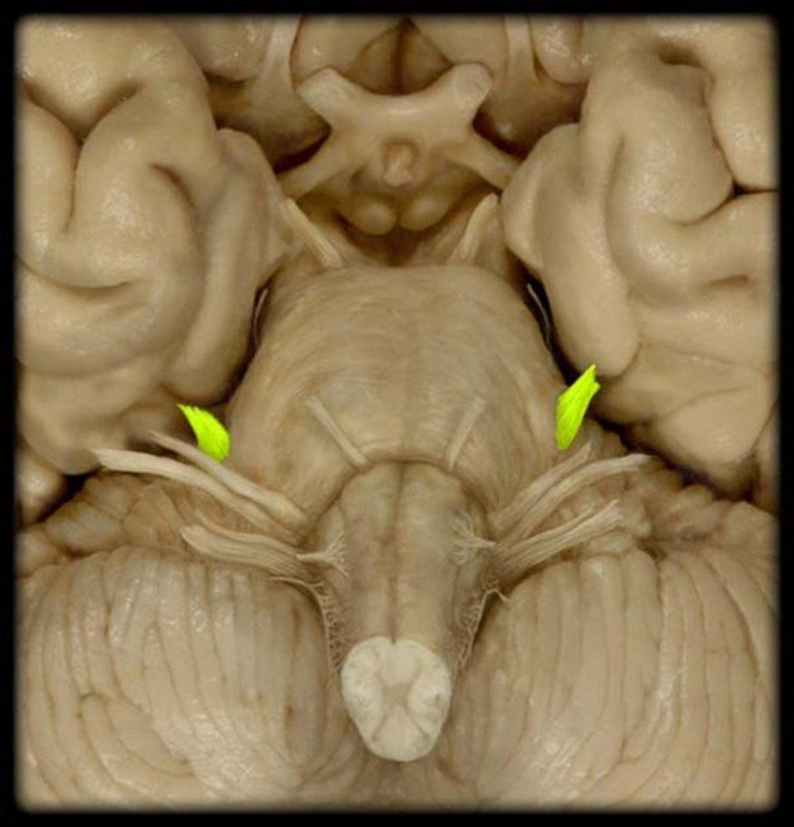 <p>Name:</p><p>Trigeminal</p><p>Sensory or Motor:</p><p>Both</p><p>Key Functions:</p><p>Face sensation, mastication</p><p>Symptoms:</p><p>Loss sensation, jaw deviates</p><p>Clinical:</p><p>Trigeminal neuralgia </p>
