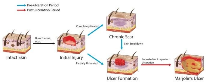 <p><strong><mark data-color="yellow" style="background-color: yellow; color: inherit;">Marjolin ulcer</mark></strong></p>
