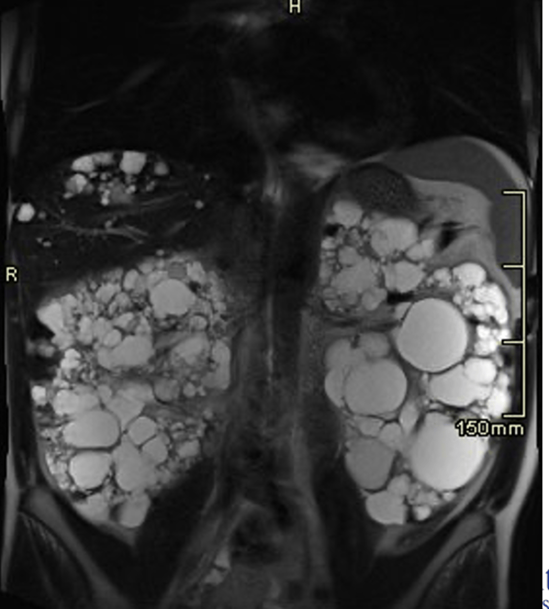 <p>Multiple renal cysts, varying sizes that are often bilateral</p>