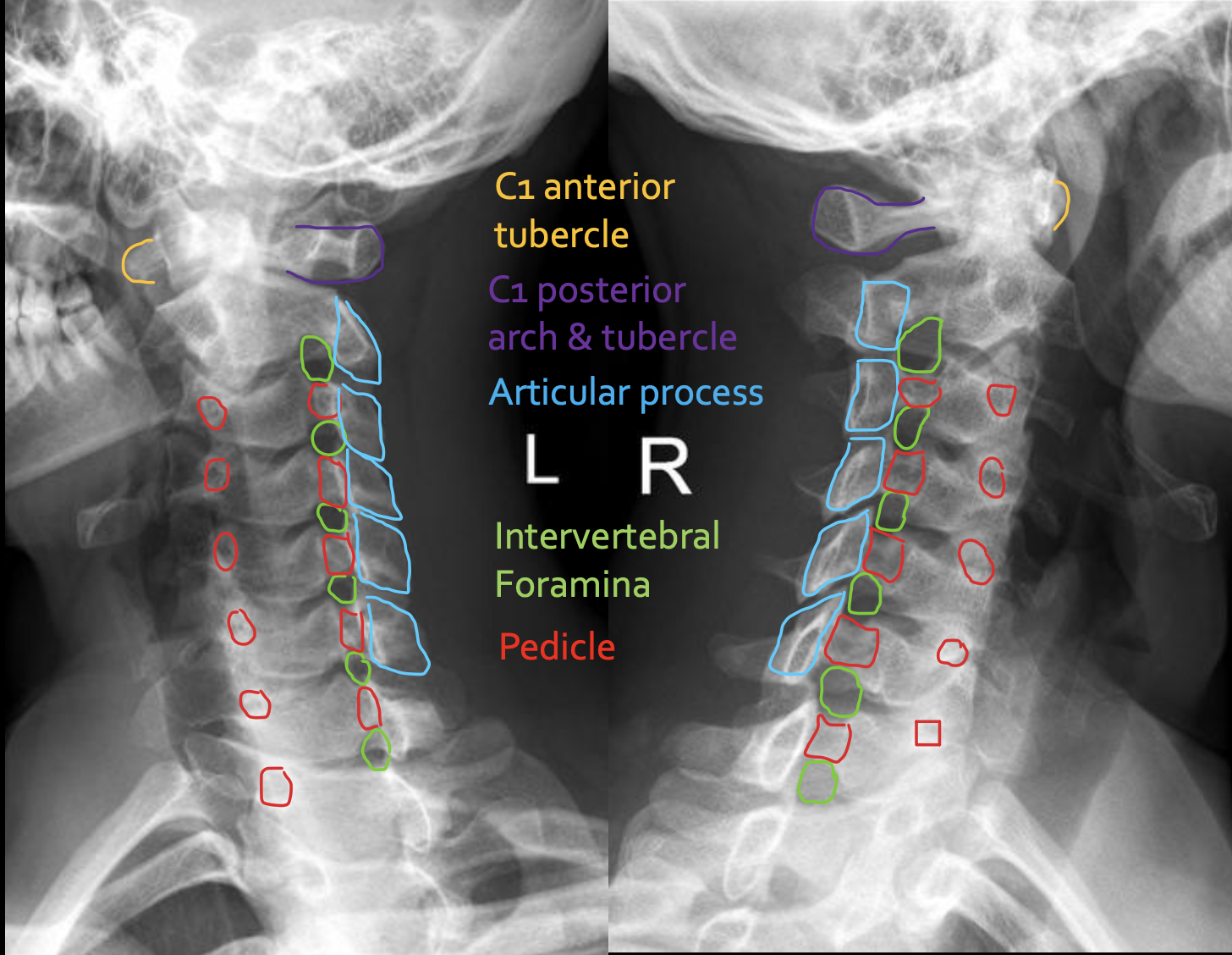 <p><span>C1 posterior arch &amp; tubercle</span></p>