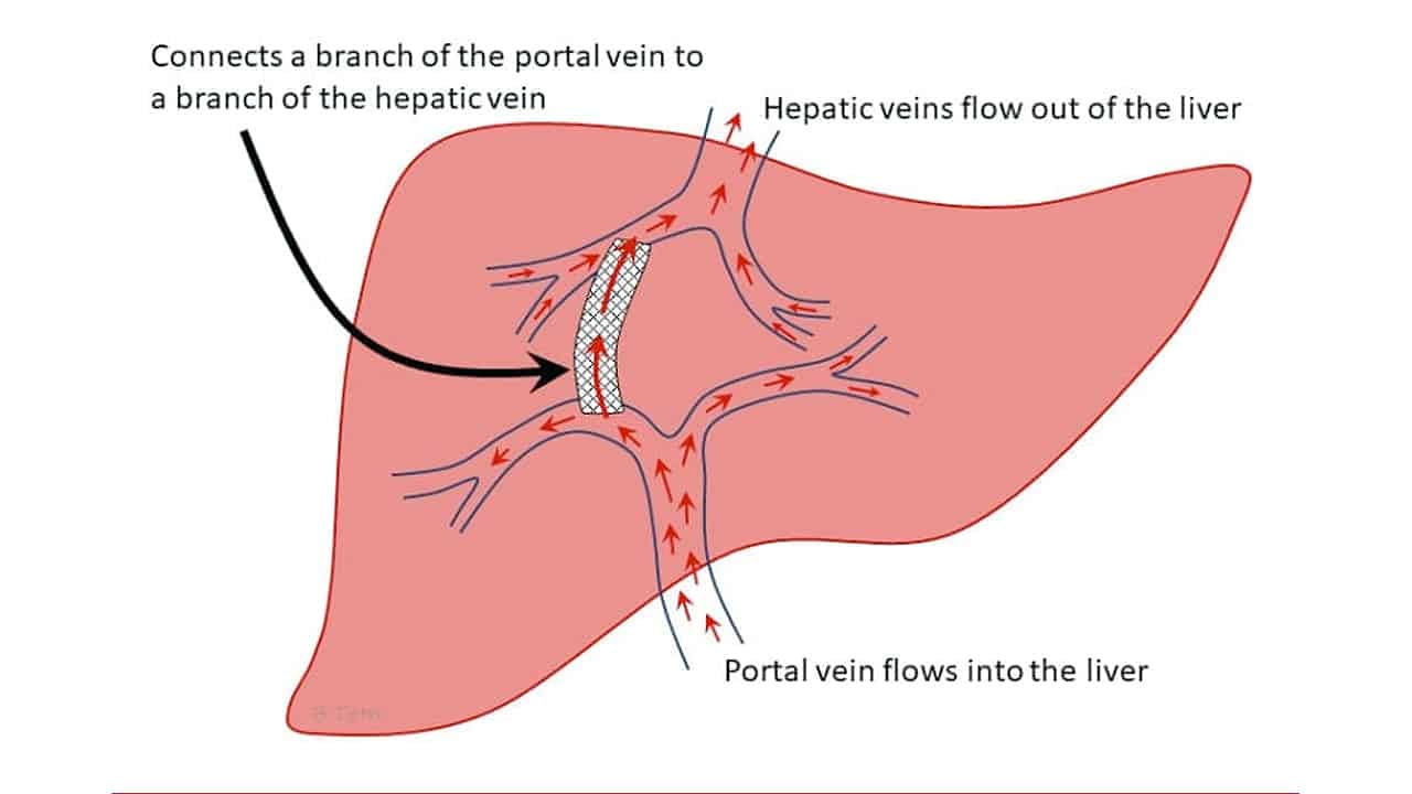 <p>Flow in TIPS - toward hepatic veins/VCI. </p><p>Flow in main portal vein - hepatopetal, towards TIPS</p><p>Flow in right and left portal veins - hepatofugal, towards TIPS</p>