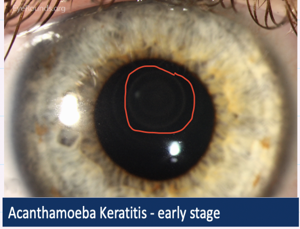 <p>Early signs </p><ul><li><p>pseudo dendrites </p></li><li><p>Radial keratoneuritis → infiltrates along corneal nerves </p></li></ul><p></p><p>Later signs :</p><ul><li><p>central ring-shaped infiltrate </p></li><li><p>stromal thinning </p></li><li><p>AC activity → flare and cells, hypopyon </p></li><li><p>scleirits </p></li></ul><p></p>