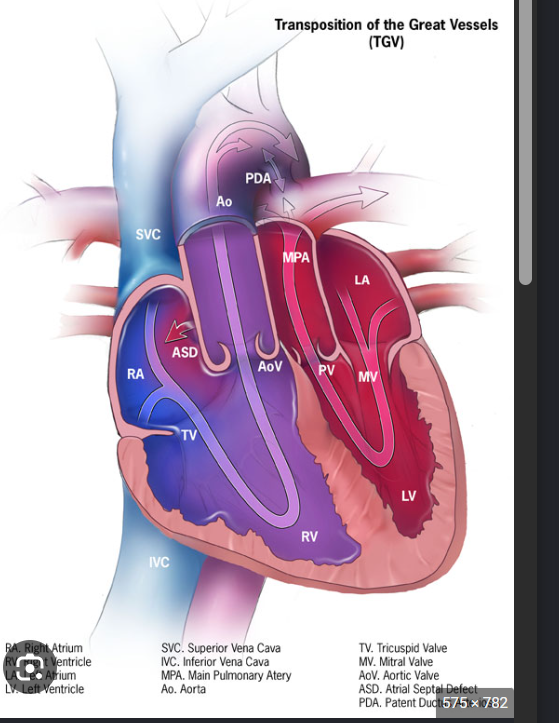 <ul><li><p>D-transposition of the great arteries (known to cause cyanosis baby)</p></li><li><p>Ebstein’s anomaly</p></li></ul><p></p>