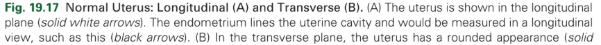 <p>Normal Uterus</p>