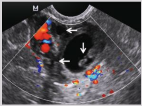 <ul><li><p>Gestational sac implants in the ovary</p></li><li><p><span style="background-color: transparent;">Increasing incidence due to PID and IUD usage</span></p><ul><li><p><span style="background-color: transparent;">IUD prevents implantation into UT&nbsp;</span></p></li></ul></li><li><p><span style="background-color: transparent;">Symptoms: low abdominal pain and bleeding</span></p></li></ul><p></p>
