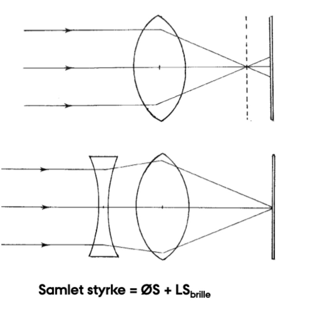 <p>Den <strong>divergerer lysstrålerne</strong>, før de når øjet, så fokus flyttes tilbage til <strong>retina</strong>.</p>