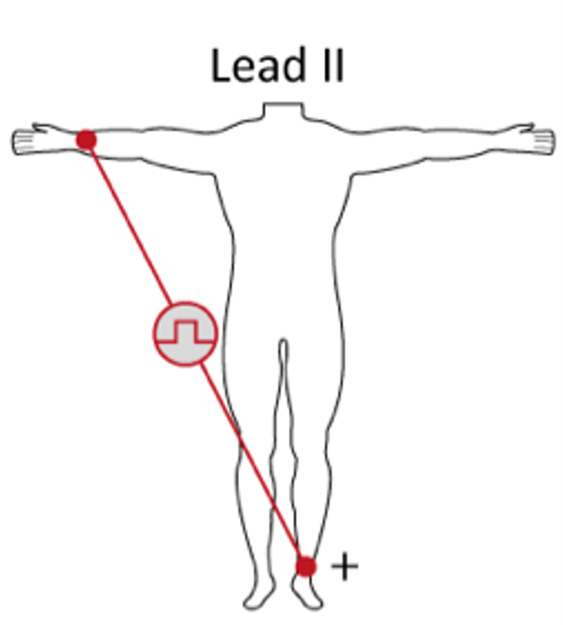 <p>Lead II</p>