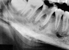 <p>describe the effect of the lesion:</p>