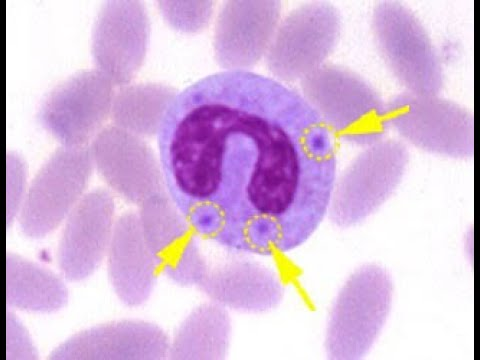 <p>- Döhle bodies are light blue-gray, oval-shaped inclusions found in the cytoplasm of neutrophils and band cells, representing remnants of rough endoplasmic reticulum. They are indicative of accelerated cell maturation or severe inflammation, commonly associated with conditions like bacterial infections, sepsis, burns, and trauma.</p>