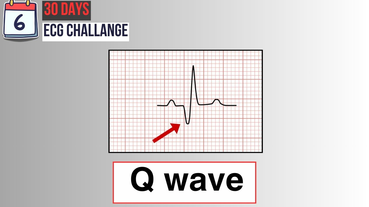 <p>Q wave</p>