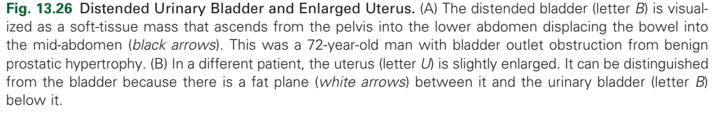 <p>distended bladder</p>