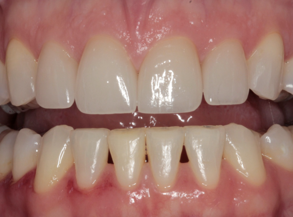 <p>Anterior teeth (include the incisors and canines for both deciduous and permanent dentition)</p>