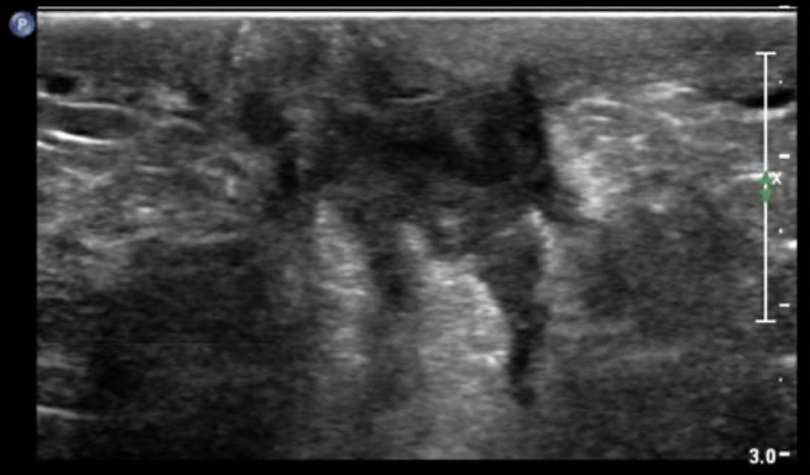 <p>s/s: mastitis</p>