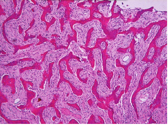 <p>fibrous dysplasia histopathologic features</p>