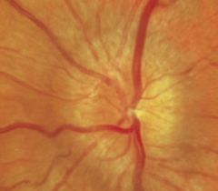 <p>How does the optic nerve appear with anterior optic neuritis?</p>