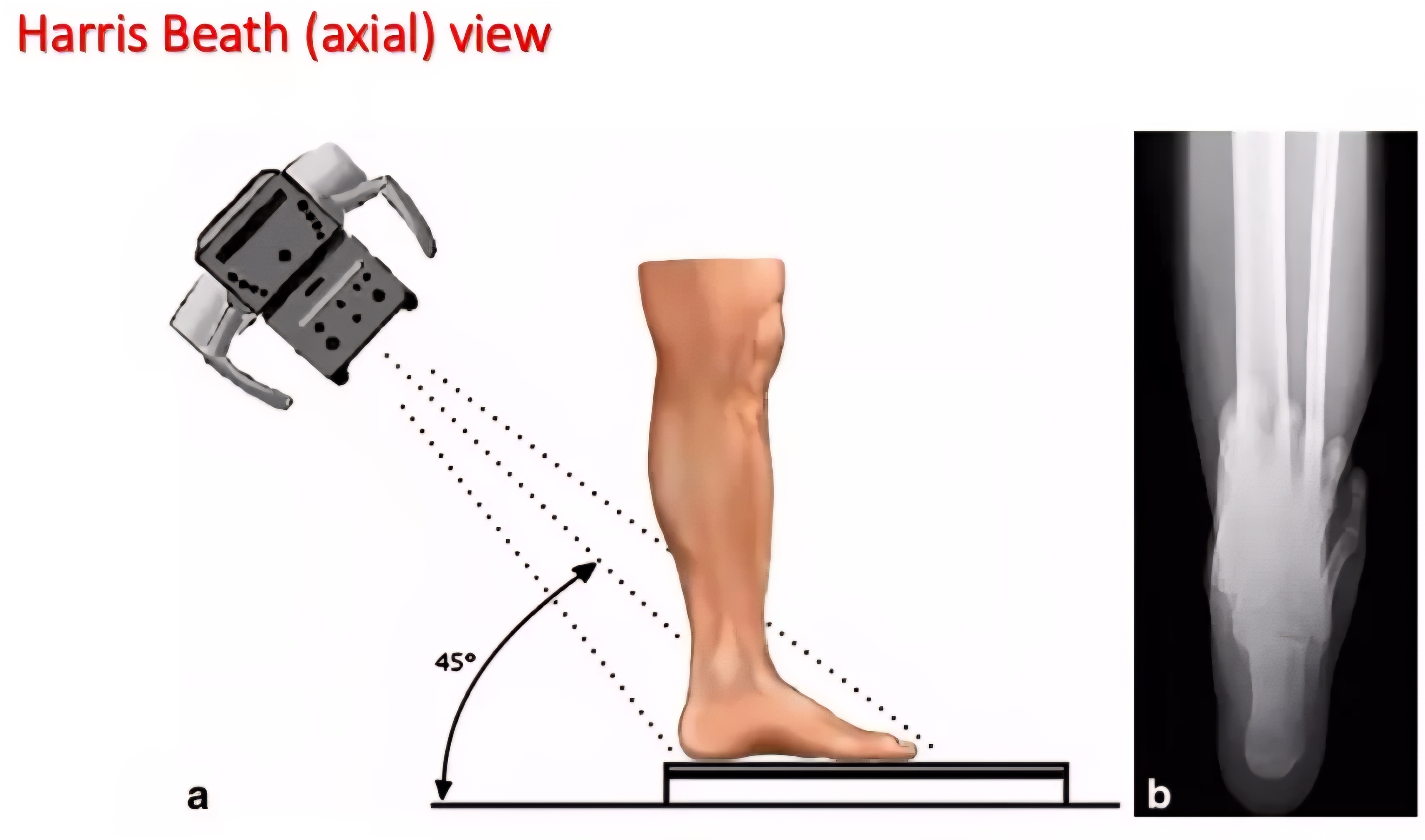 <p>Weight-bearing axial projection used to visualize the calcaneus, subtalar joint facets, and sustentaculum tali</p>