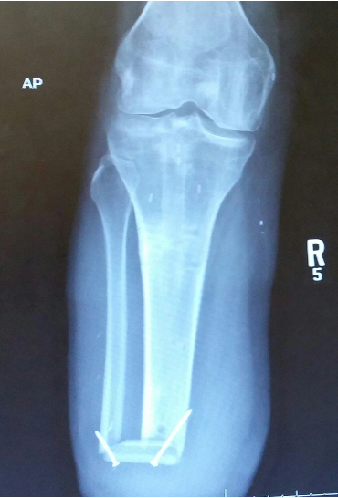 <p>transtibial (TT) </p>