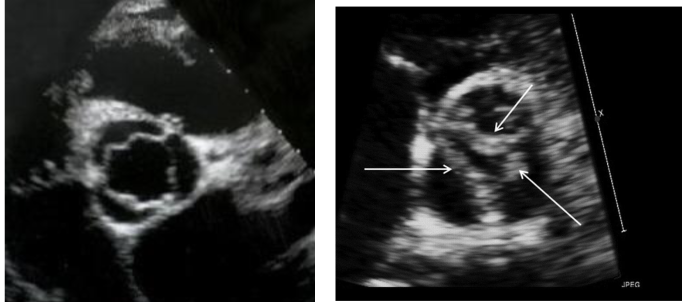 <ul><li><p><strong>Aortic Stenosis</strong>: <strong>reduced (restricted) opening </strong>of the aortic valve in systole via calcium build up over time</p><ul><li><p>valve appears brighter than normal, does not open well, has velocity over 2.5 m/s</p></li></ul></li><li><p><strong>Aortic Sclerosis</strong>: thickening of the valve leaflets with <strong>no restriction </strong>of blood flow</p><ul><li><p>valve appears brighter than normal, still opens well, has velocity less than 2.5 m/s</p></li></ul></li></ul><p></p>