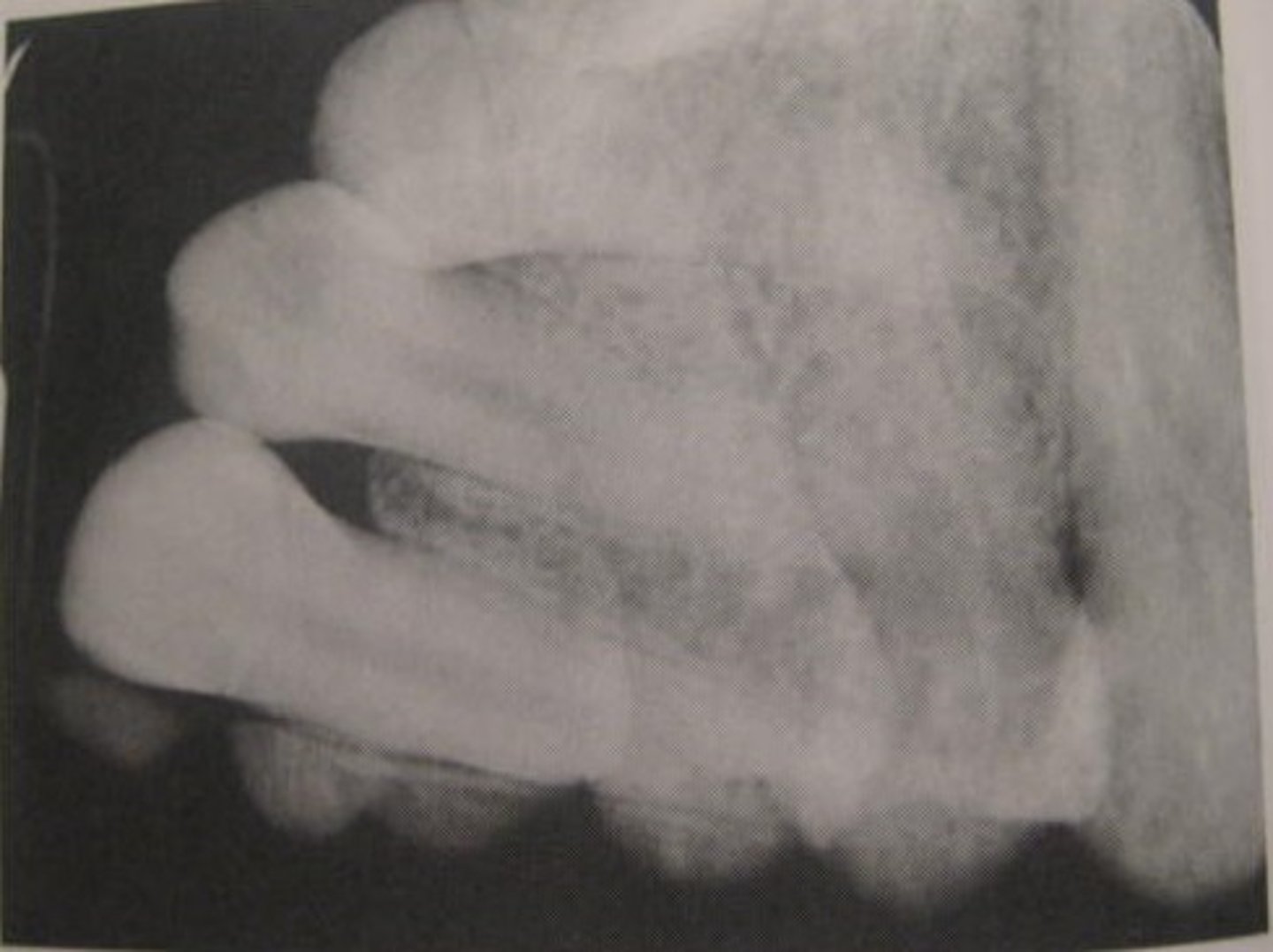 <p>What causes too many teeth and distorted teeth on an image?</p>