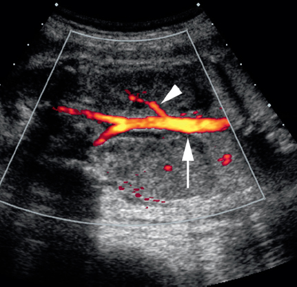 <p>Absent kidney</p><p>Compensatory hypertrophy of the contralateral kidney</p><p>Visible urinary bladder</p><p>Normal amniotic fluid volume</p><p>Unilateral lying-down adrenal sign</p><p>Undetectable renal artery branch with color Doppler (unilateral)</p>