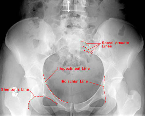 <p>low ridge, more delicate than crest (where muscles attach)</p>