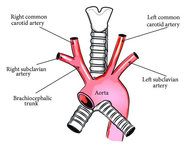 <p>Aberrant subclavian arteries</p>