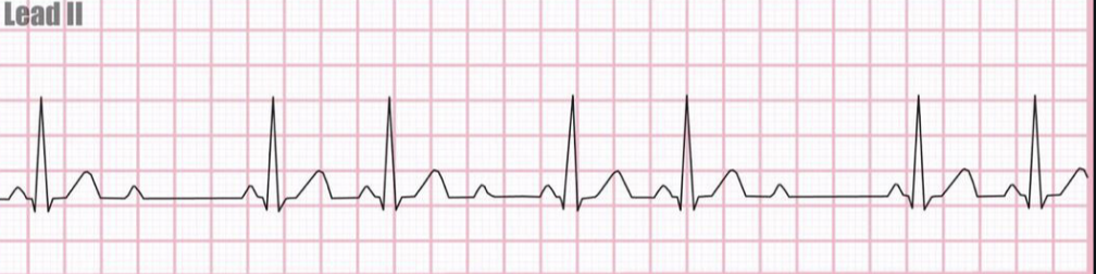 <p>the image shown depicts what cardiac arrhythmia?</p>