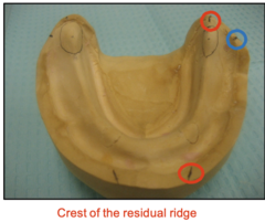 <p>It is important that we mark the crest of the mandibular ridge correctly because, if we set teeth too buccally, what would happen?</p>