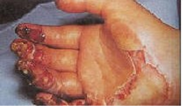 <p>full thickness; damage to dermis and epidermis and adnexal structures</p>