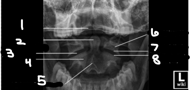 <p>what is number 5 on this odontoid x-ray?</p>