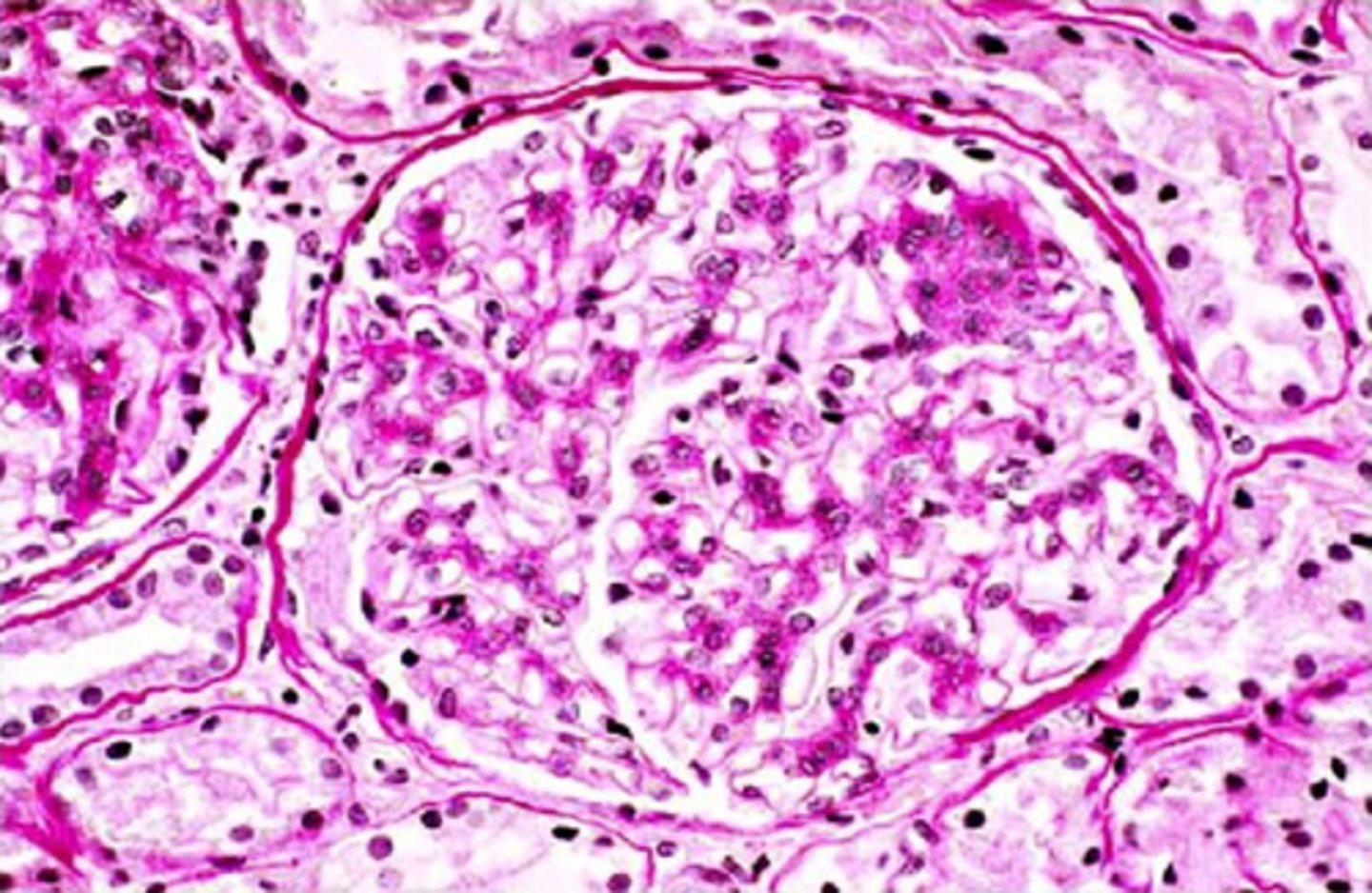 <p>PAS</p><p>Feedback:</p><p>The stain shown in this image is the PAS. It has stained basement membranes rose. The ather stains listed would not stain basement membranes. Congo red demonstrates amyloid; mucicarmine and aldehyde fuchsin stain acidic mucins.</p>