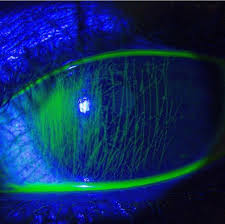 <ul><li><p>when px blinks the FB will rub against their cornea - vertical linear staining on cornea </p></li><li><p>can cause corneal abrasion and pain and irritation </p></li></ul><p></p>