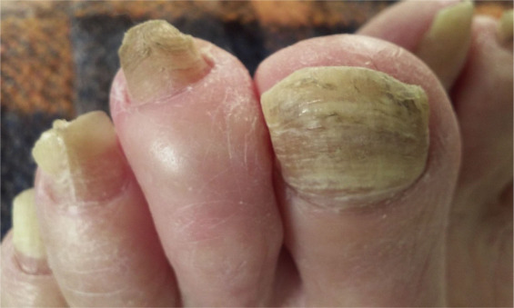 <p>Onychomycosis (tinea unguium) diagnosis</p>