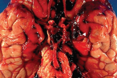<p>What are common causes of subarachnoid hemorrhage?</p>