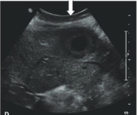 <p>Hyperechoic lesion (white bold arrow) with peripheral halo-target sign-highly specific for metastases-lung cancer</p>