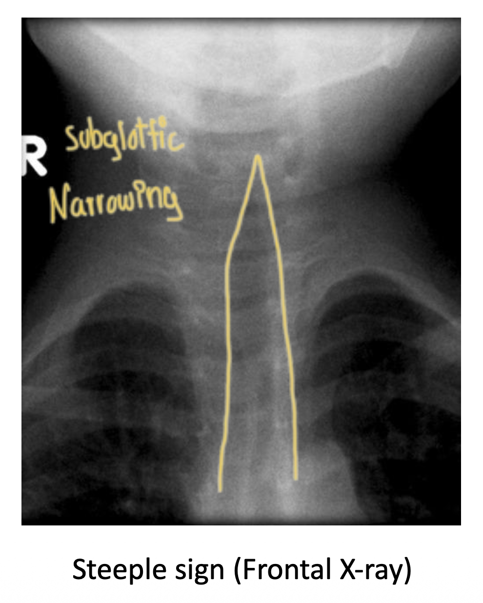 <p>"Inflammation of the larynx and trachea usually caused by Parainfluenza virus<br><br><strong>Presentation:</strong> Child with fever, barking "seal-like"" cough <br>*croup = poop on a seal in a church; churches have steeples and a big influen(za)ce<br><br><strong>Lung sound:</strong> Inspiratory stridor<br><br><strong>Tracheal deviation & percussion:</strong> None<br><br><strong>Imaging:</strong> "Steeple sign"" on frontal neck x-ray (subglottic narrowing) *Difference b/w epiglottitis & croup</p>
